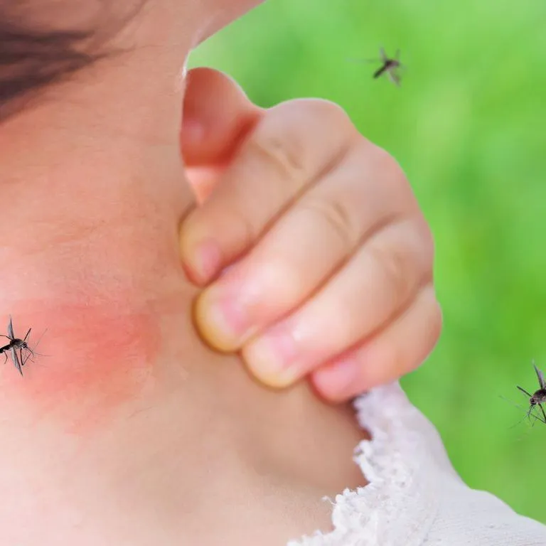 Piqûre de moustique sur la peau d'un enfant